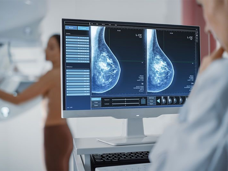 Μαστογραφία: Ο Πολυτιμότερος Σύμμαχος στην Πρόληψη του Καρκίνου του  Μαστού