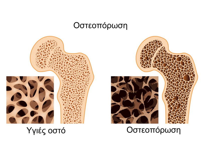 Οστεοπόρωση: Πρόληψη σήμερα, ποιότητα ζωής αύριο